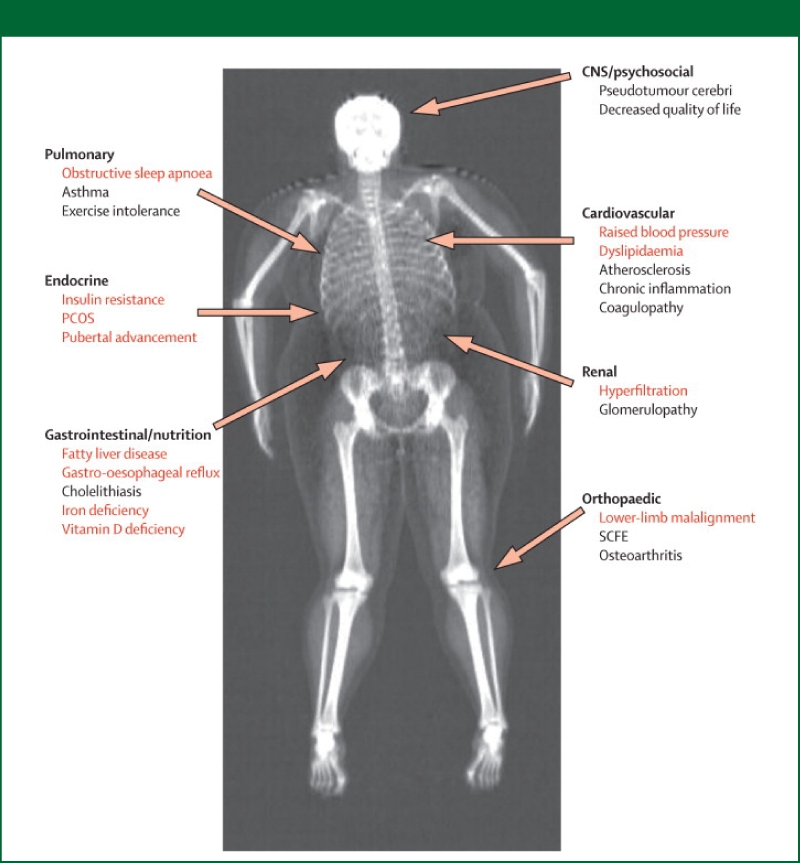 Figure 2: Complications associated with childhood obesity
