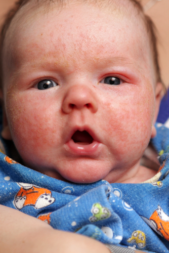 Baby with eczema